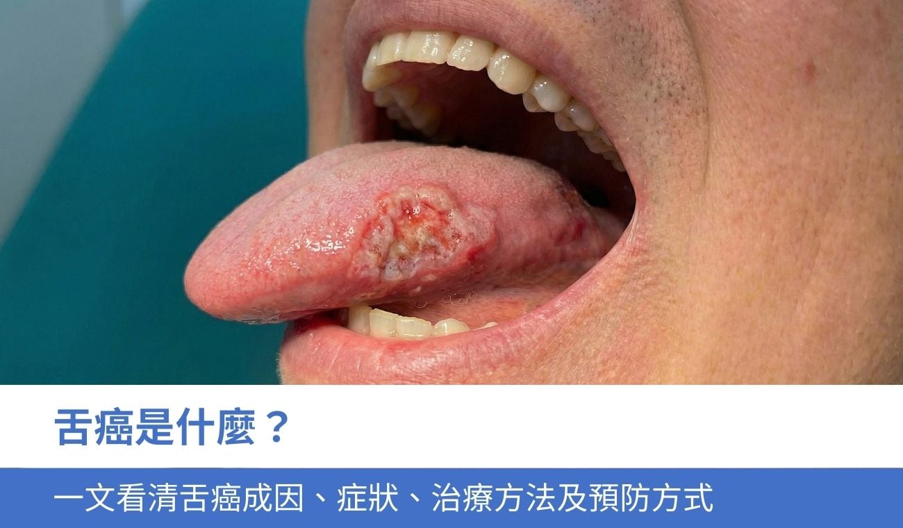 tongue-cancer 舌癌是什麼?一文看清舌癌成因、症狀、治療方法及預防方式