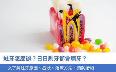 蛀牙怎麼辦？日日刷牙都會爛牙？一文了解3大蛀牙原因、症狀、治療方法、預防措施