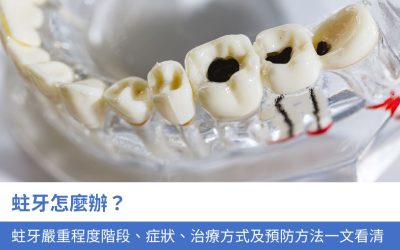 蛀牙怎麼辦？蛀牙嚴重程度 3 階段、症狀、治療方式及預防方法一文看清