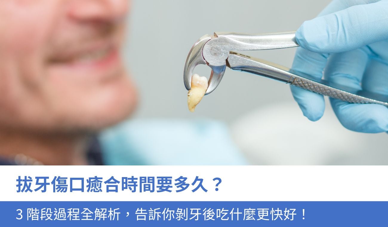 拔牙傷口癒合時間要多久？