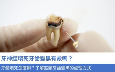 牙神經壞死牙齒變黑有救嗎?牙髓壞死怎麼辦?整顆牙齒變黑的4大處理方式