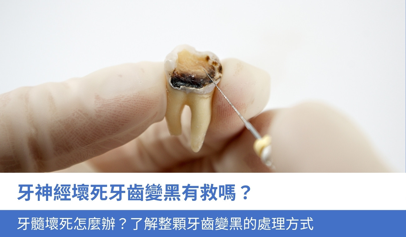 tooth-turning-black-after-nerve-death-solutions 牙神經壞死牙齒變黑有救嗎?牙髓壞死怎麼辦?整顆牙齒變黑的4大處理方式