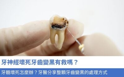 牙神經壞死牙齒變黑有救嗎？牙髓壞死怎麼辦？牙醫分享整顆牙齒變黑的4大處理方式