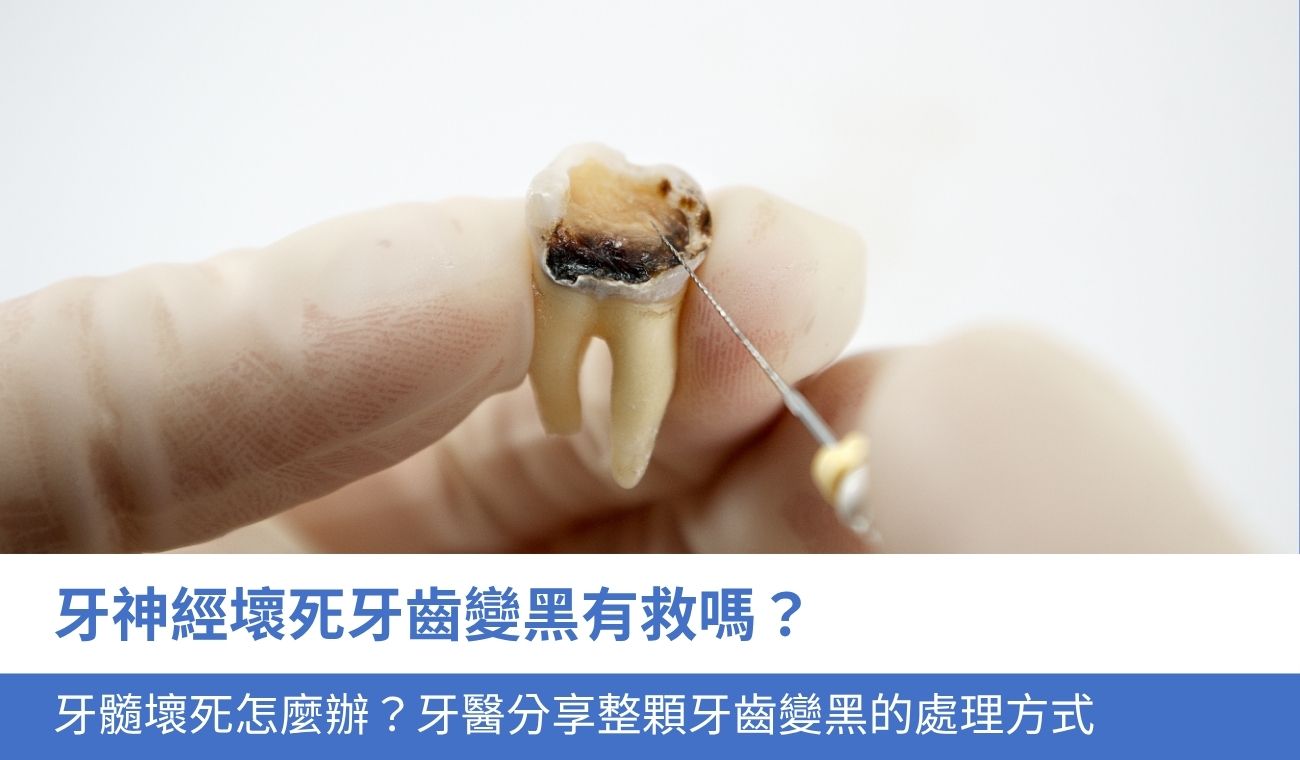 牙神經壞死牙齒變黑怎麼辦？有救嗎？牙醫話你知牙齒變黑的4大處理方法