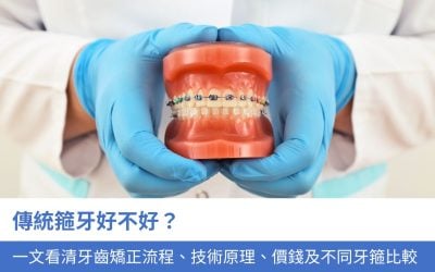 傳統箍牙好不好？一文看清 牙齒矯正流程、技術原理、價錢及不同牙箍的比較