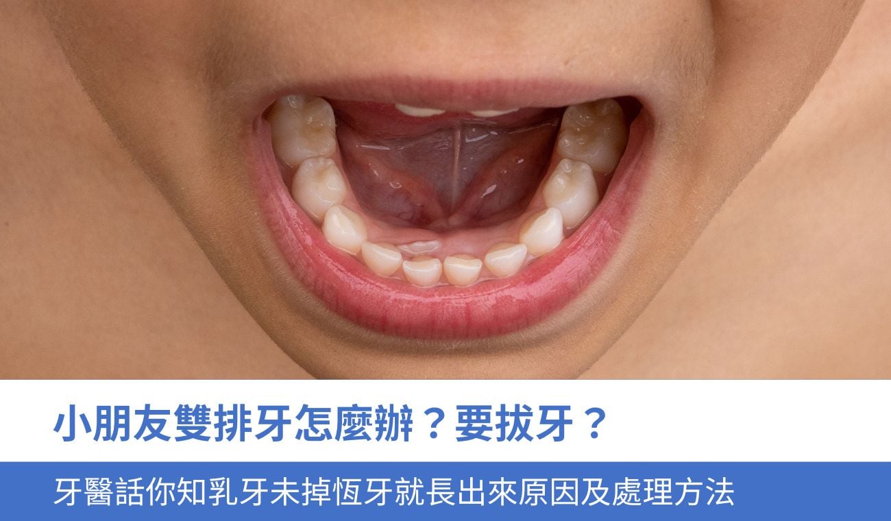 小朋友雙排牙怎麼辦？