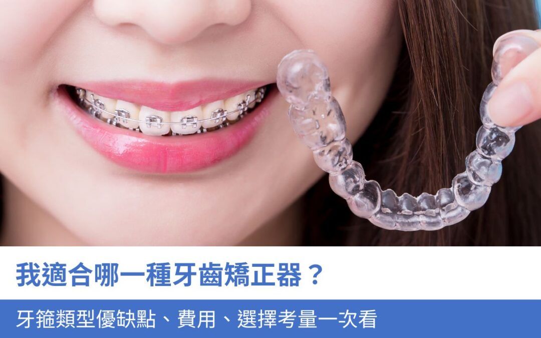 我適合哪一種牙齒矯正方式？4大牙箍類型優缺點、費用、選擇考量一次看