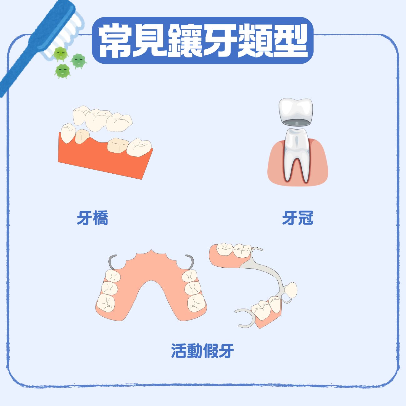 假牙全攻略:活動假牙 vs 固定假牙怎麼選?2大鑲牙種類、流程、價錢及護理注意事項一次看 4 常見鑲牙類型