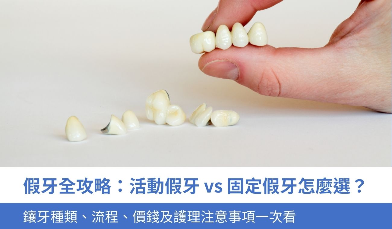 types-of-dentures 假牙全攻略:活動假牙 vs 固定假牙怎麼選?2大鑲牙種類、流程、價錢一次看