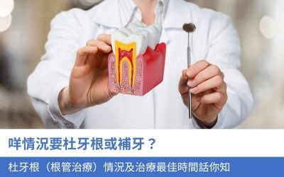 咩情況要杜牙根或補牙？4大 杜牙根（根管治療）情況及治療最佳時間話你知