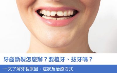 牙齒斷裂怎麼辦？要植牙、拔牙嗎？一文了解牙裂3大原因、症狀及治療方式
