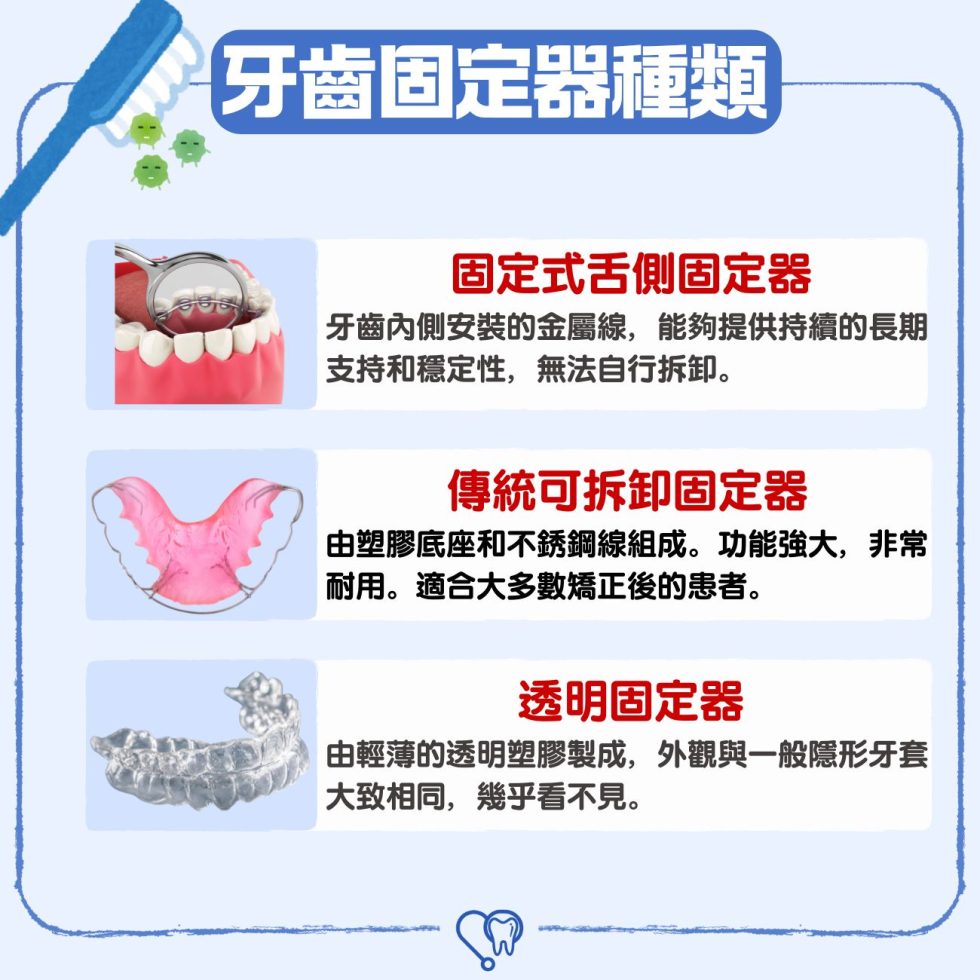 為什麼箍牙後牙齒要佩戴 固定器？3大矯正牙齒固定器 Retainer 種類及價錢話你知