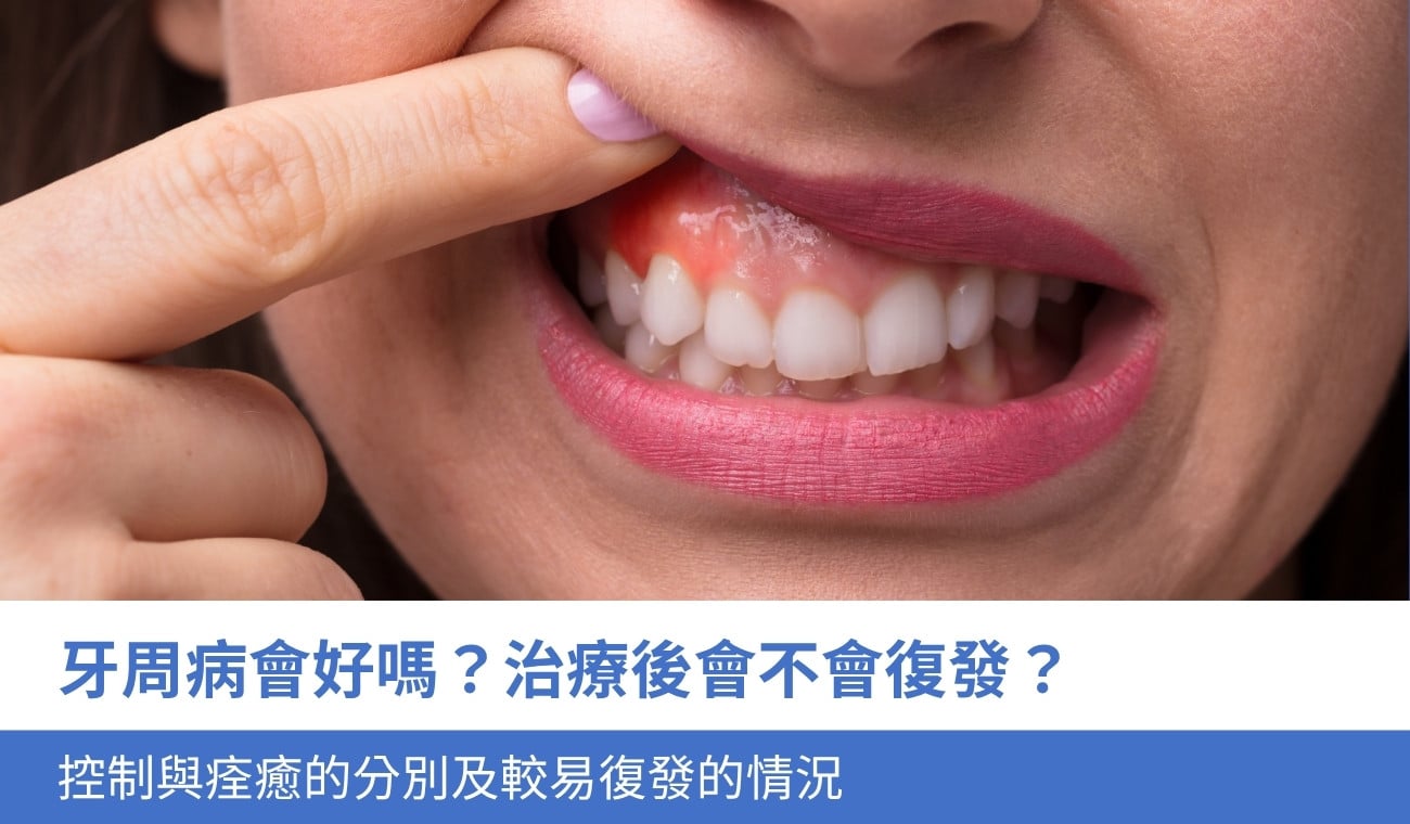 will-periodontal-disease-come-back 牙周病會好嗎?治療後會不會復發?控制與痊癒的分別及 4 類較易復發的情況