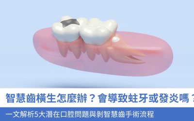 智慧齒橫生怎麼辦？會導致蛀牙或發炎嗎？一文解析5大潛在口腔問題與剝智慧齒手術流程