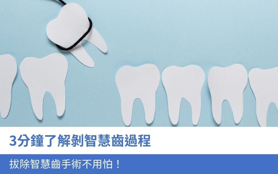 3分鐘了解剝智慧齒過程，拔除智慧齒手術不用怕