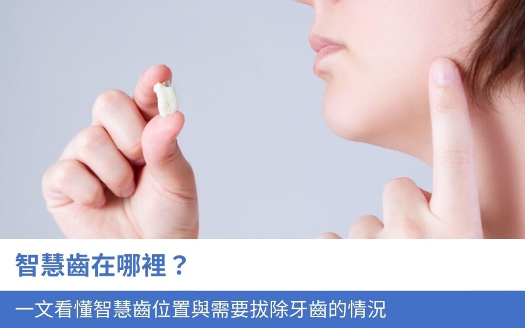 智慧齒在哪裡？一文看懂智慧齒位置與3大 需要拔除牙齒的情況